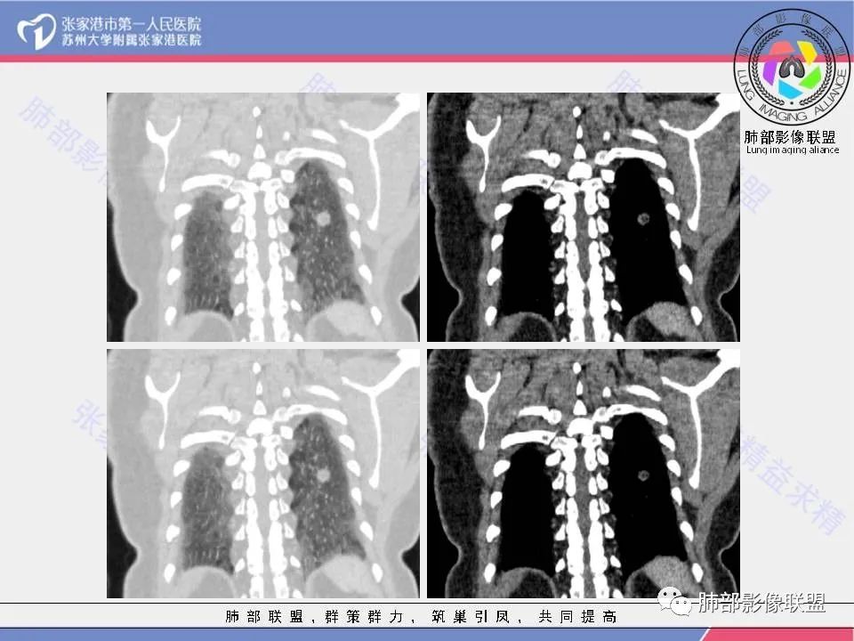 影像PPT - 【病例】一例肺胶样腺癌伴中心粗钙化灶CT-17 影像PPT - 【病例】一例肺胶样腺癌伴中心粗钙化灶CT-17
