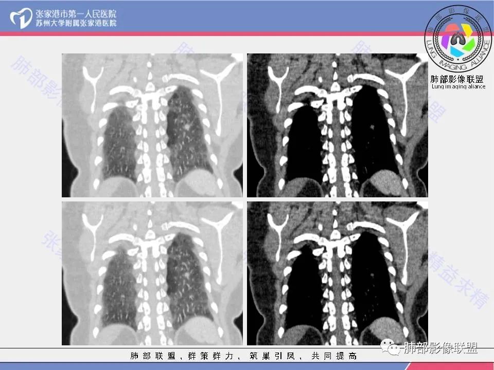 影像PPT - 【病例】一例肺胶样腺癌伴中心粗钙化灶CT-19 影像PPT - 【病例】一例肺胶样腺癌伴中心粗钙化灶CT-19