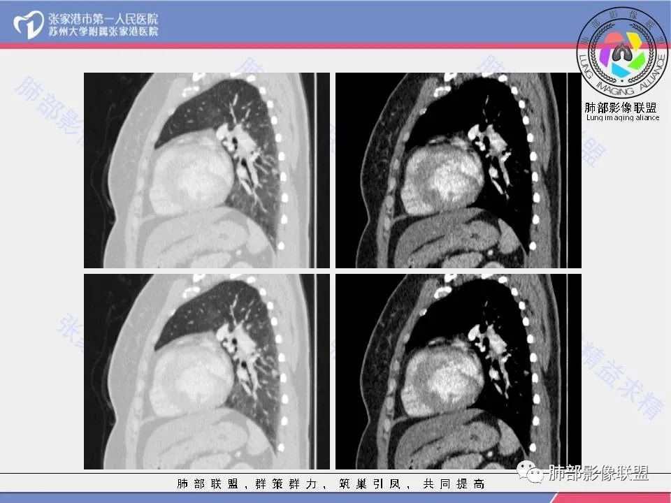 影像PPT - 【病例】一例肺胶样腺癌伴中心粗钙化灶CT-20 影像PPT - 【病例】一例肺胶样腺癌伴中心粗钙化灶CT-20