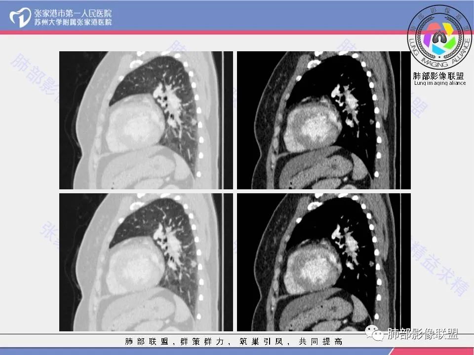 影像PPT - 【病例】一例肺胶样腺癌伴中心粗钙化灶CT-22 影像PPT - 【病例】一例肺胶样腺癌伴中心粗钙化灶CT-22