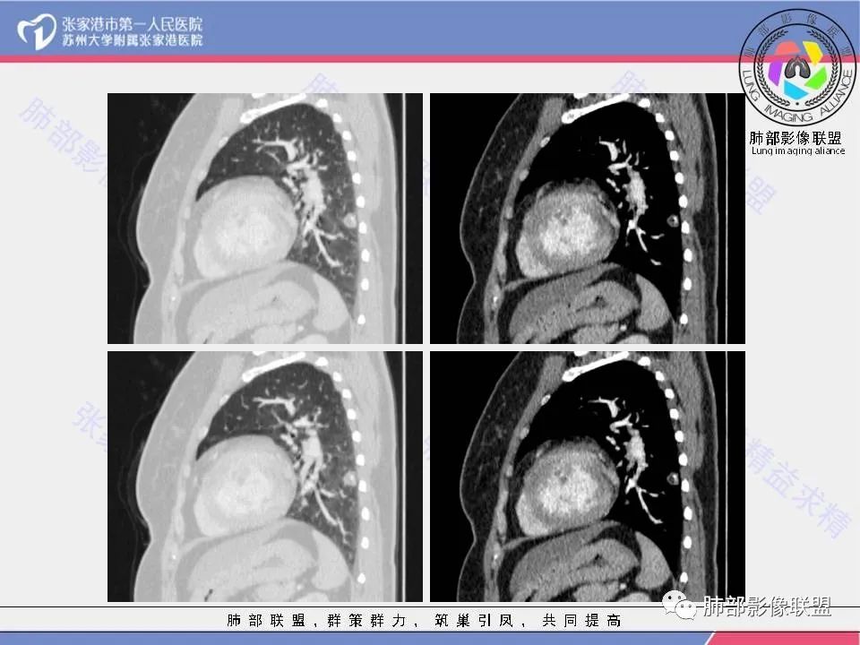 影像PPT - 【病例】一例肺胶样腺癌伴中心粗钙化灶CT-25 影像PPT - 【病例】一例肺胶样腺癌伴中心粗钙化灶CT-25