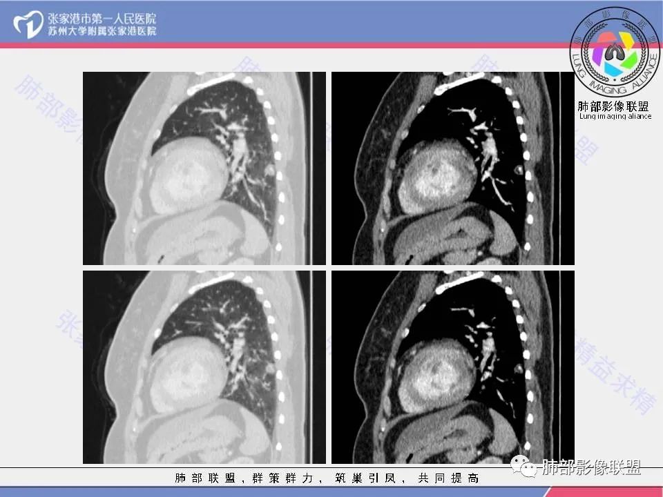影像PPT - 【病例】一例肺胶样腺癌伴中心粗钙化灶CT-26 影像PPT - 【病例】一例肺胶样腺癌伴中心粗钙化灶CT-26