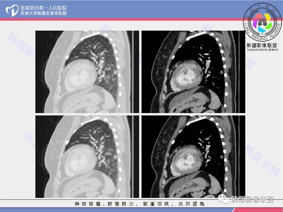 影像PPT - 【病例】一例肺胶样腺癌伴中心粗钙化灶CT-27 影像PPT - 【病例】一例肺胶样腺癌伴中心粗钙化灶CT-27