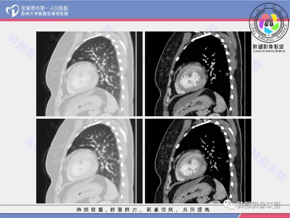 影像PPT - 【病例】一例肺胶样腺癌伴中心粗钙化灶CT-28 影像PPT - 【病例】一例肺胶样腺癌伴中心粗钙化灶CT-28