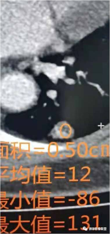 影像PPT - 【病例】一例肺胶样腺癌伴中心粗钙化灶CT-29 影像PPT - 【病例】一例肺胶样腺癌伴中心粗钙化灶CT-29
