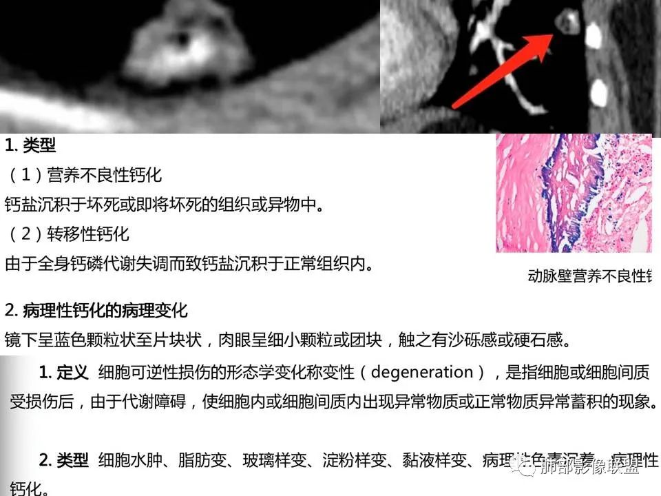 影像PPT - 【病例】一例肺胶样腺癌伴中心粗钙化灶CT-31 影像PPT - 【病例】一例肺胶样腺癌伴中心粗钙化灶CT-31