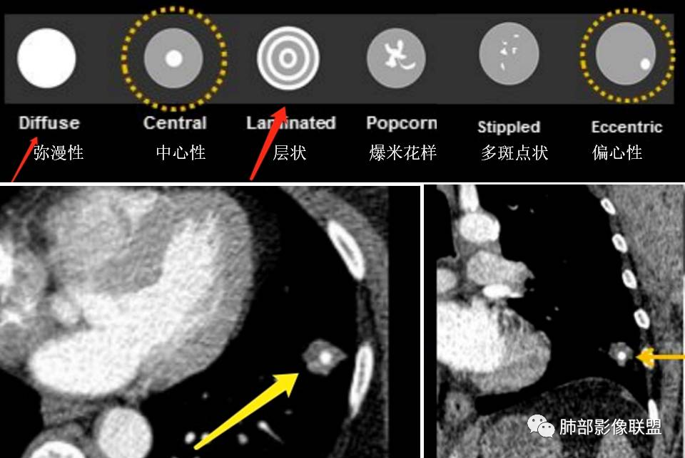 影像PPT - 【病例】一例肺胶样腺癌伴中心粗钙化灶CT-32 影像PPT - 【病例】一例肺胶样腺癌伴中心粗钙化灶CT-32