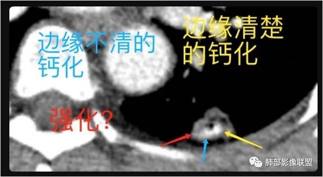 影像PPT - 【病例】一例肺胶样腺癌伴中心粗钙化灶CT-35 影像PPT - 【病例】一例肺胶样腺癌伴中心粗钙化灶CT-35