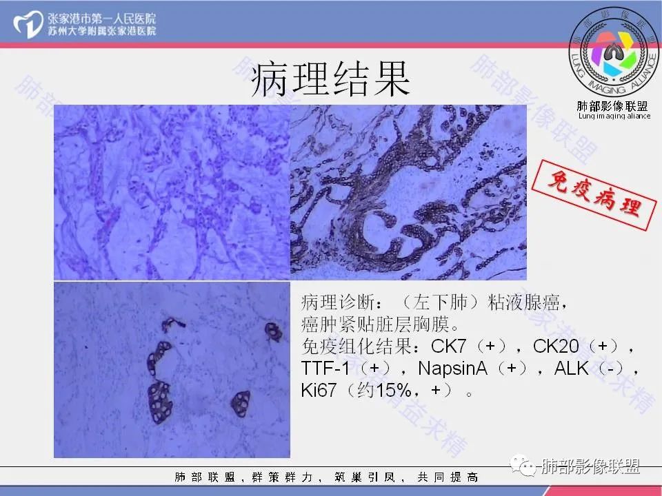影像PPT - 【病例】一例肺胶样腺癌伴中心粗钙化灶CT-36 影像PPT - 【病例】一例肺胶样腺癌伴中心粗钙化灶CT-36