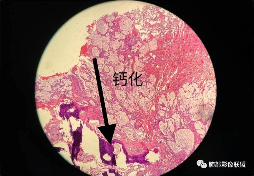 影像PPT - 【病例】一例肺胶样腺癌伴中心粗钙化灶CT-37 影像PPT - 【病例】一例肺胶样腺癌伴中心粗钙化灶CT-37