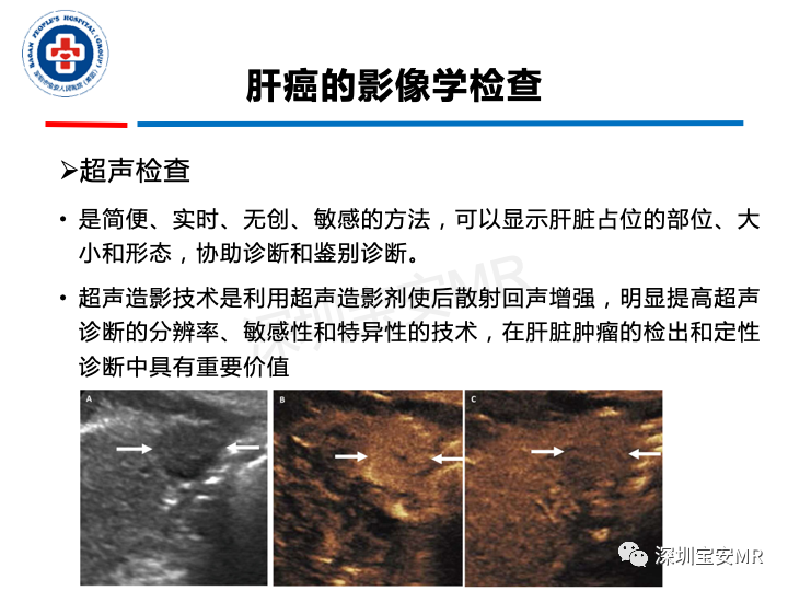 影像PPT - 【PPT】原发性肝癌影像检查-7