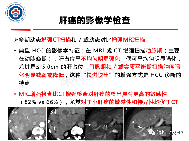 影像PPT - 【PPT】原发性肝癌影像检查-8