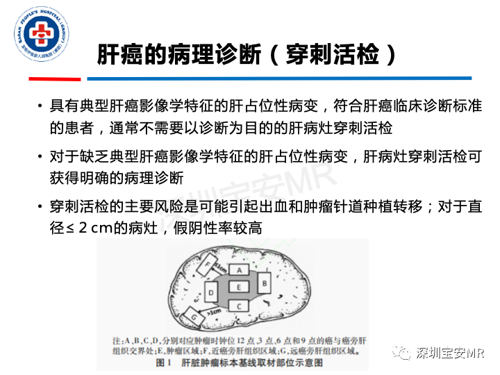影像PPT - 【PPT】原发性肝癌影像检查-10