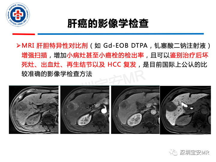 影像PPT - 【PPT】原发性肝癌影像检查-9