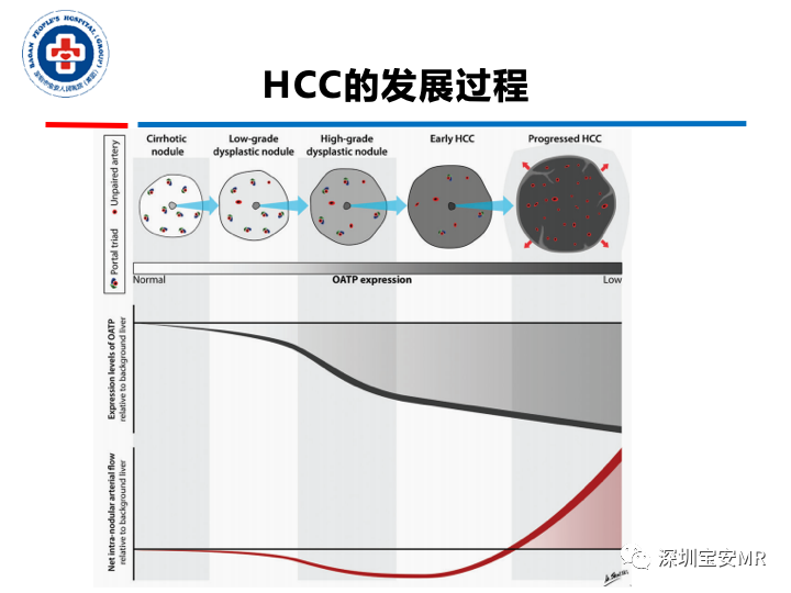 影像PPT - 【PPT】原发性肝癌影像检查-11