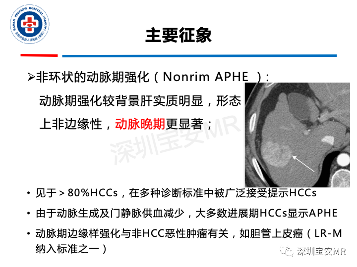 影像PPT - 【PPT】原发性肝癌影像检查-19