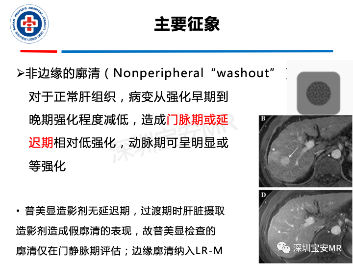 影像PPT - 【PPT】原发性肝癌影像检查-20