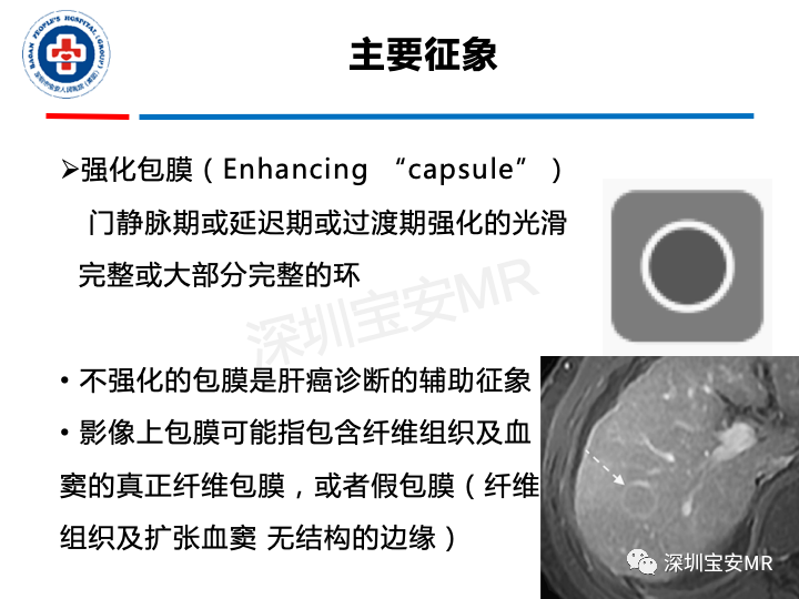 影像PPT - 【PPT】原发性肝癌影像检查-21