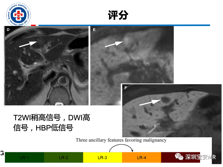 影像PPT - 【PPT】原发性肝癌影像检查-27