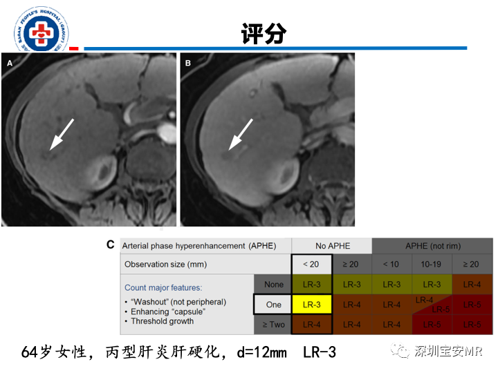 影像PPT - 【PPT】原发性肝癌影像检查-28