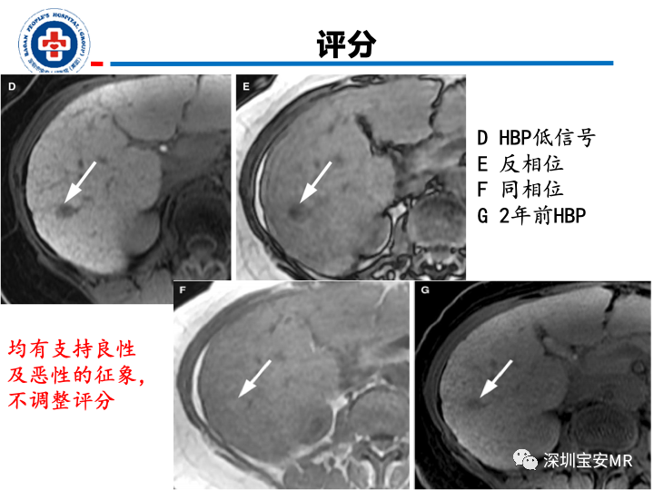 影像PPT - 【PPT】原发性肝癌影像检查-29