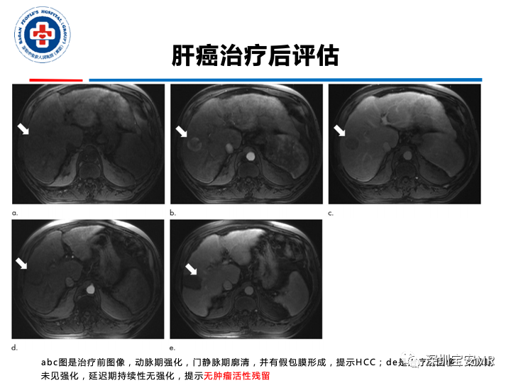 影像PPT - 【PPT】原发性肝癌影像检查-34