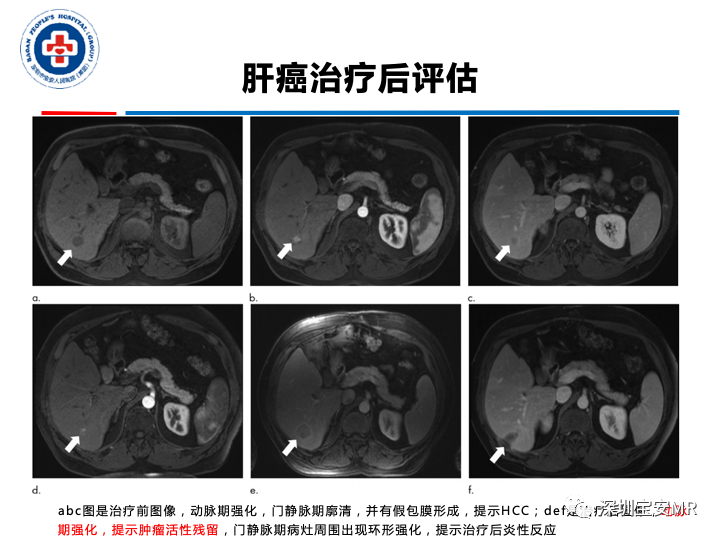 影像PPT - 【PPT】原发性肝癌影像检查-35
