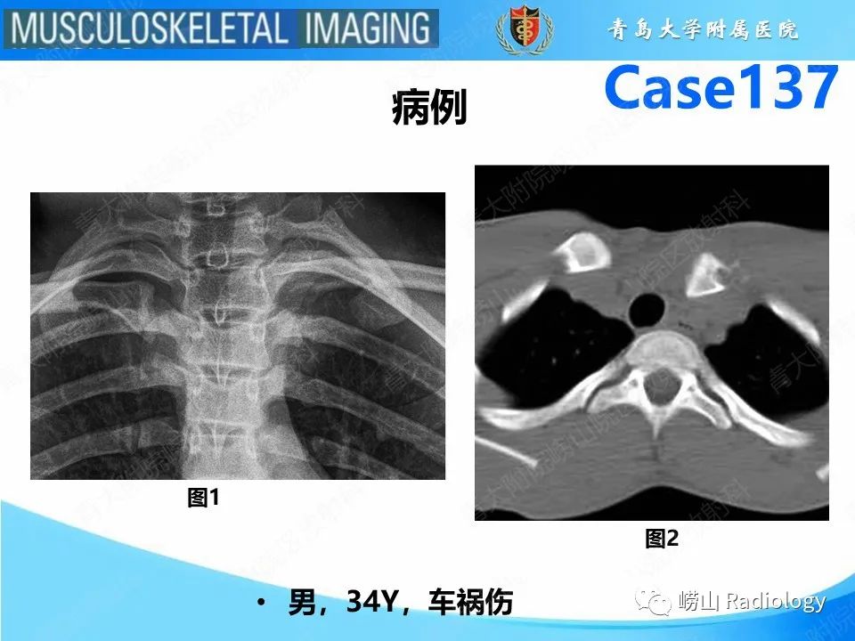 影像PPT - 【PPT】胸锁关节脱位-2