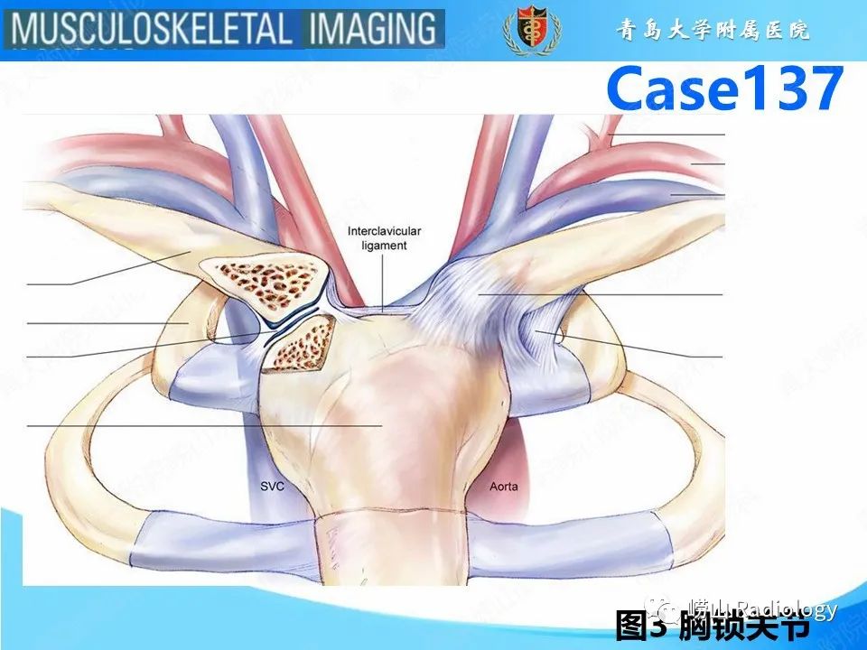 影像PPT - 【PPT】胸锁关节脱位-6