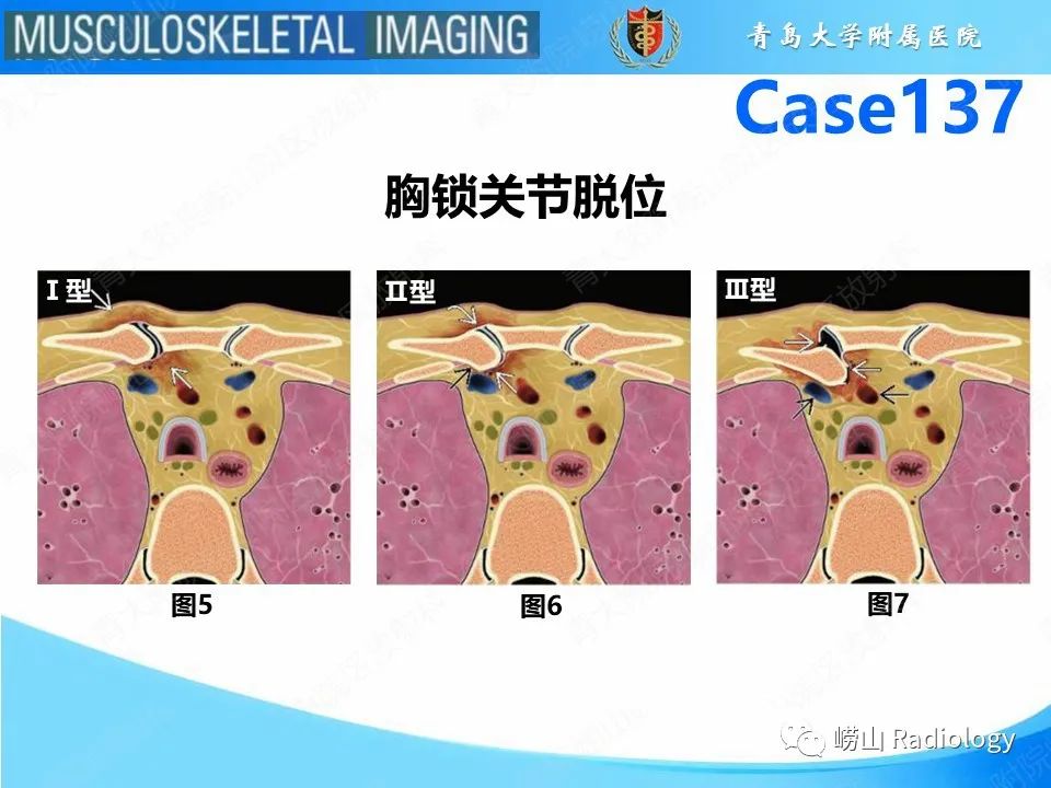 影像PPT - 【PPT】胸锁关节脱位-10