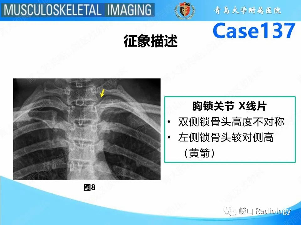影像PPT - 【PPT】胸锁关节脱位-20