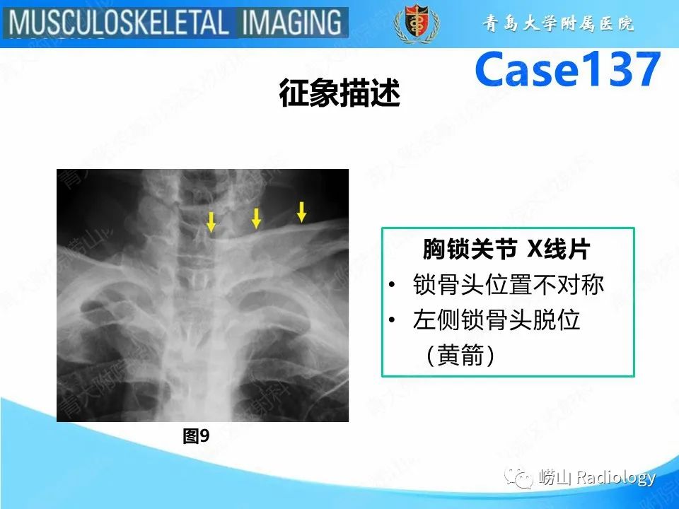 影像PPT - 【PPT】胸锁关节脱位-21