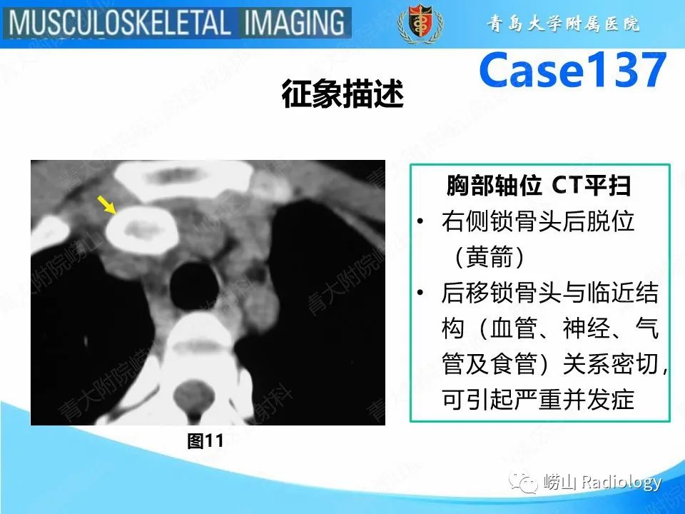 影像PPT - 【PPT】胸锁关节脱位-23