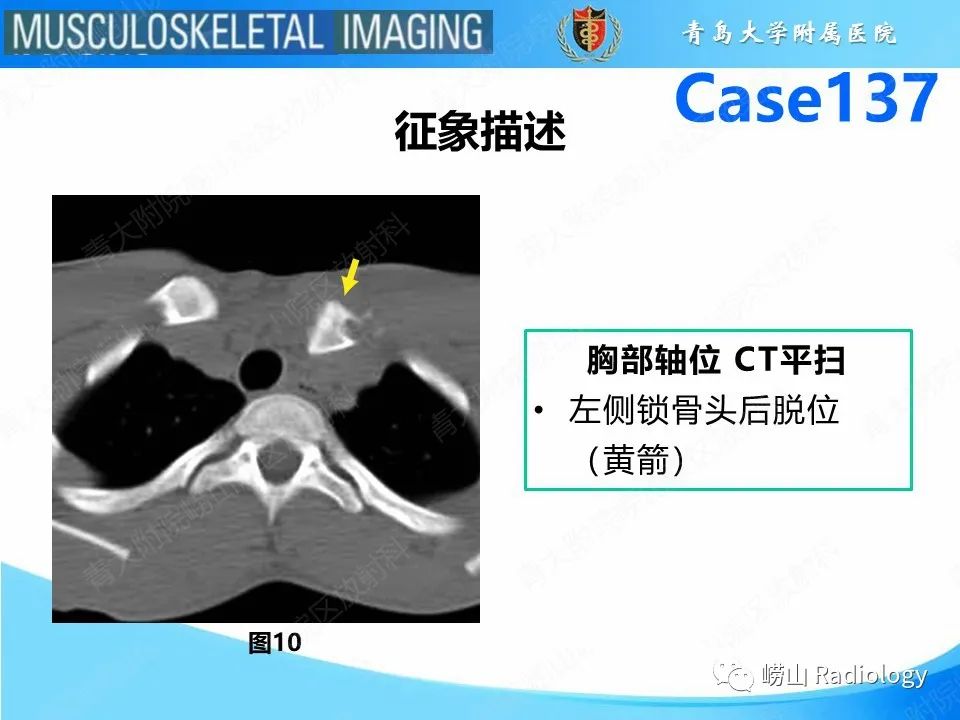 影像PPT - 【PPT】胸锁关节脱位-22
