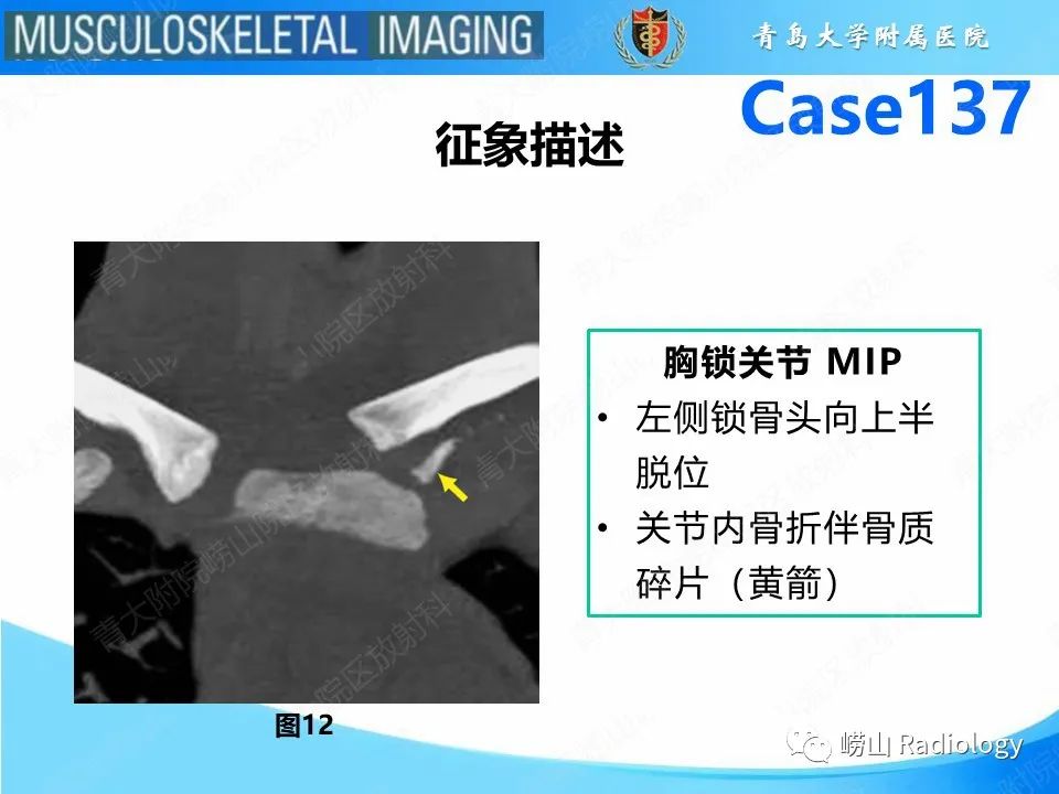 影像PPT - 【PPT】胸锁关节脱位-24