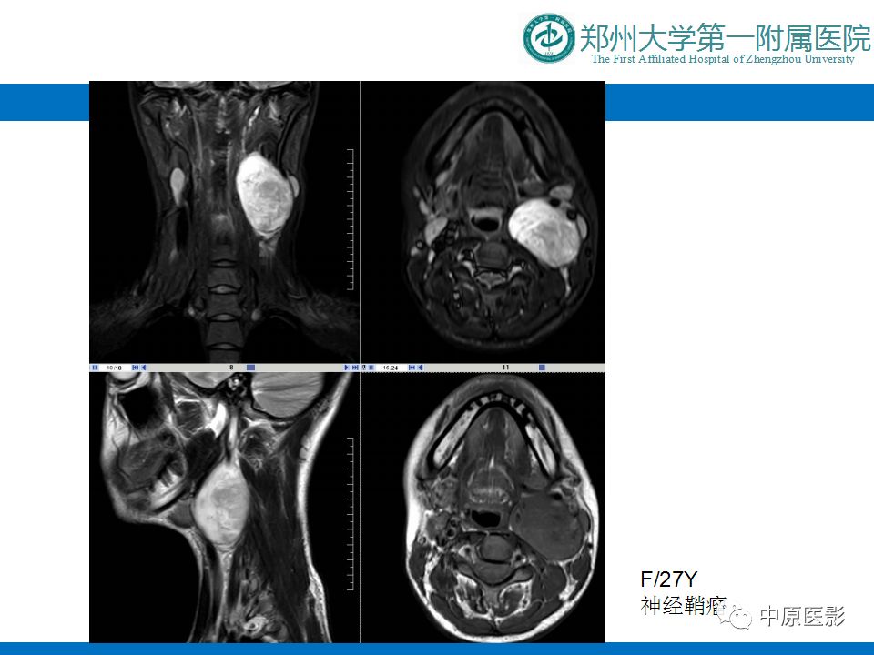 影像PPT - 【PPT】颈部神经源性肿瘤的磁共振成像-12