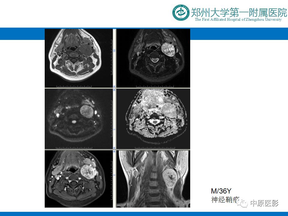 影像PPT - 【PPT】颈部神经源性肿瘤的磁共振成像-11