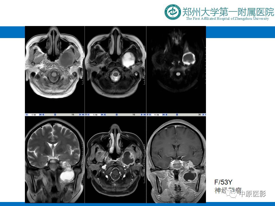 影像PPT - 【PPT】颈部神经源性肿瘤的磁共振成像-13