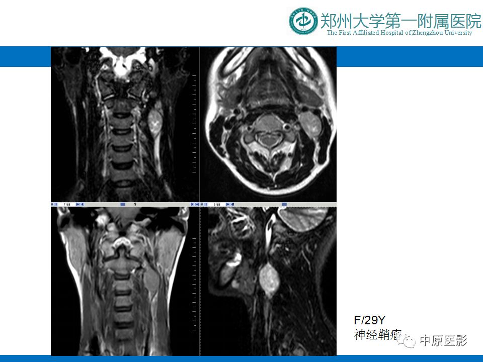 影像PPT - 【PPT】颈部神经源性肿瘤的磁共振成像-15