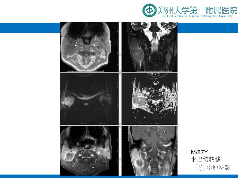 影像PPT - 【PPT】颈部神经源性肿瘤的磁共振成像-19