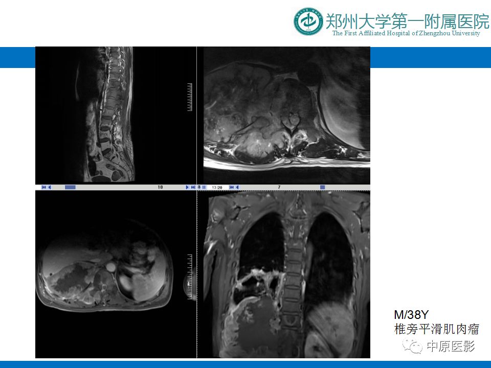 影像PPT - 【PPT】颈部神经源性肿瘤的磁共振成像-20