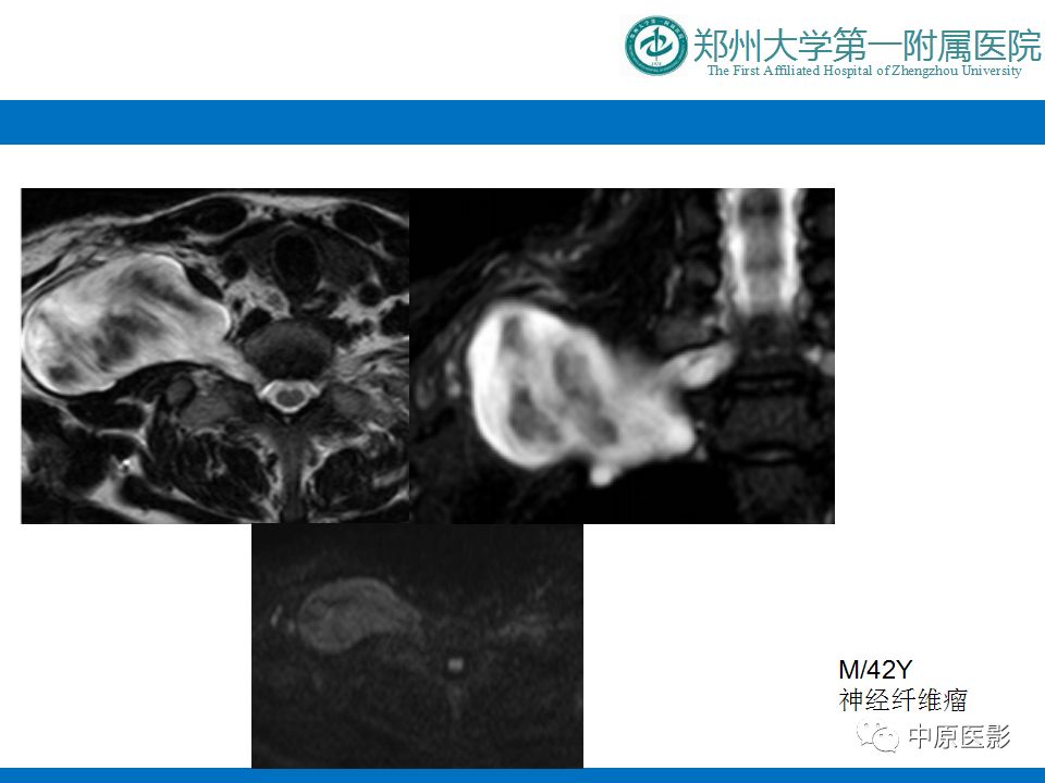 影像PPT - 【PPT】颈部神经源性肿瘤的磁共振成像-28