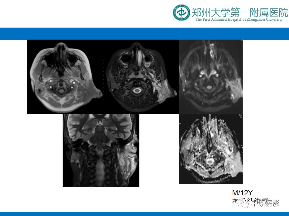 影像PPT - 【PPT】颈部神经源性肿瘤的磁共振成像-27
