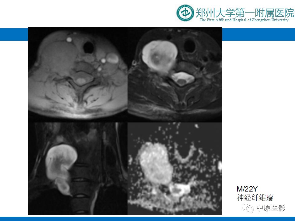 影像PPT - 【PPT】颈部神经源性肿瘤的磁共振成像-29