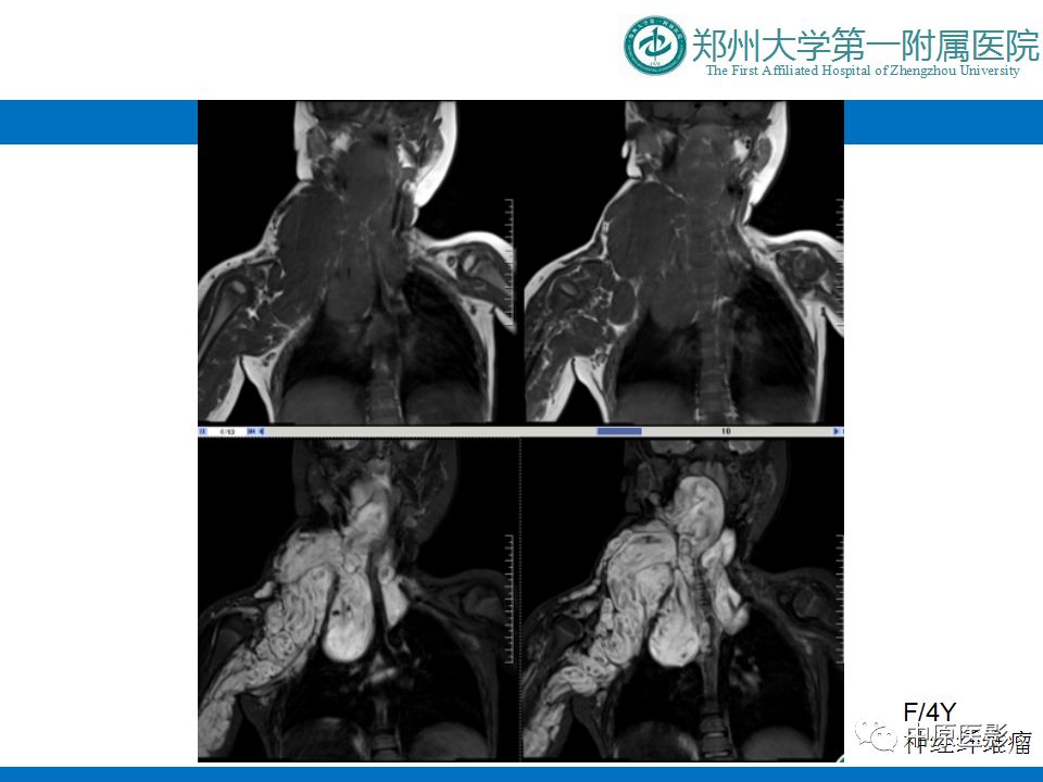 影像PPT - 【PPT】颈部神经源性肿瘤的磁共振成像-31