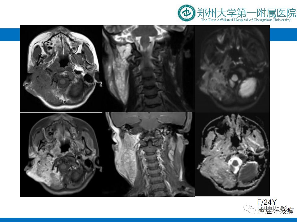 影像PPT - 【PPT】颈部神经源性肿瘤的磁共振成像-30