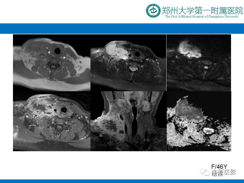 影像PPT - 【PPT】颈部神经源性肿瘤的磁共振成像-35