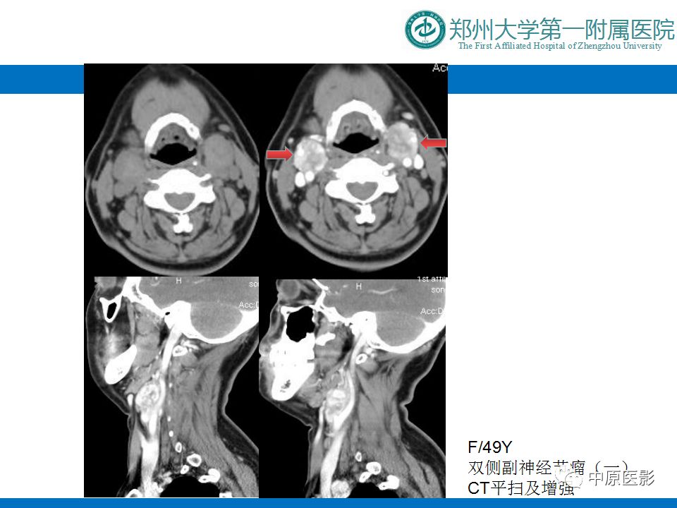 影像PPT - 【PPT】颈部神经源性肿瘤的磁共振成像-41