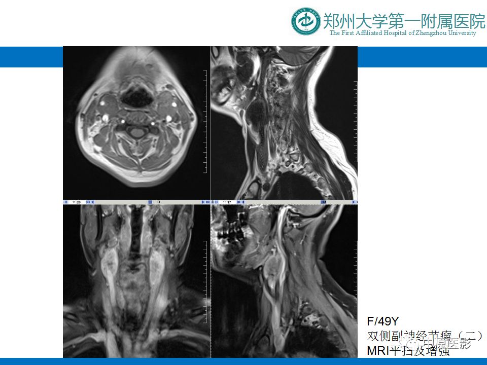 影像PPT - 【PPT】颈部神经源性肿瘤的磁共振成像-42