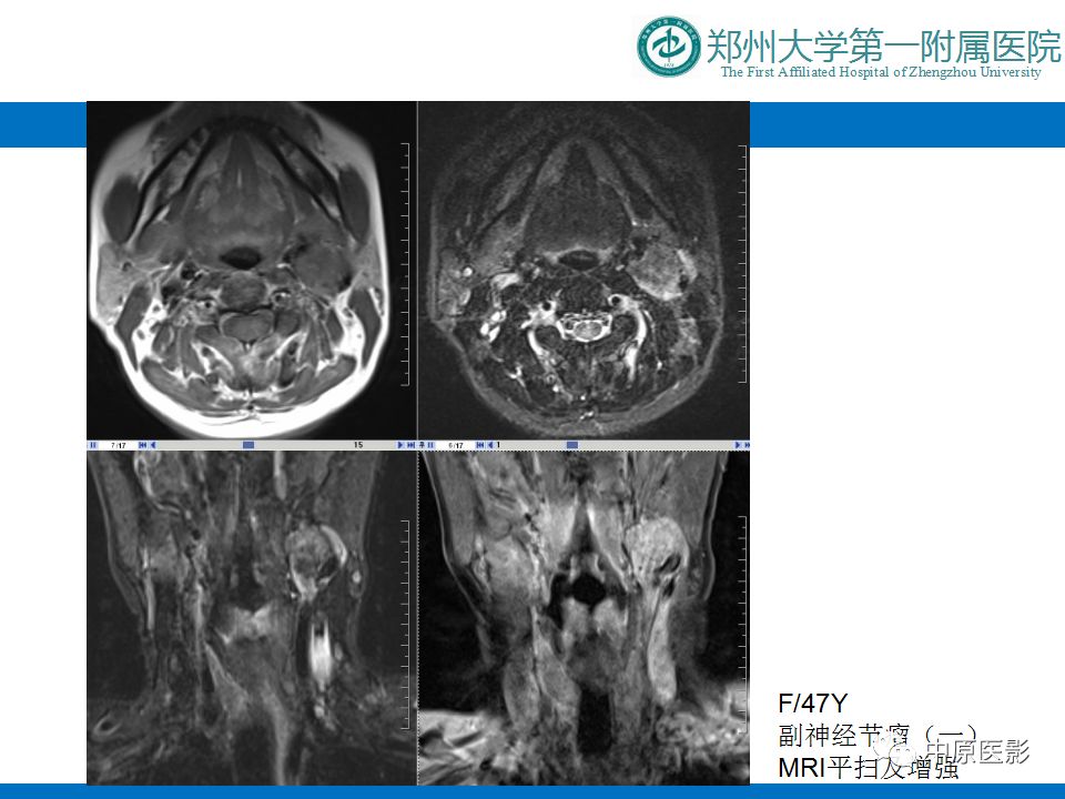 影像PPT - 【PPT】颈部神经源性肿瘤的磁共振成像-44